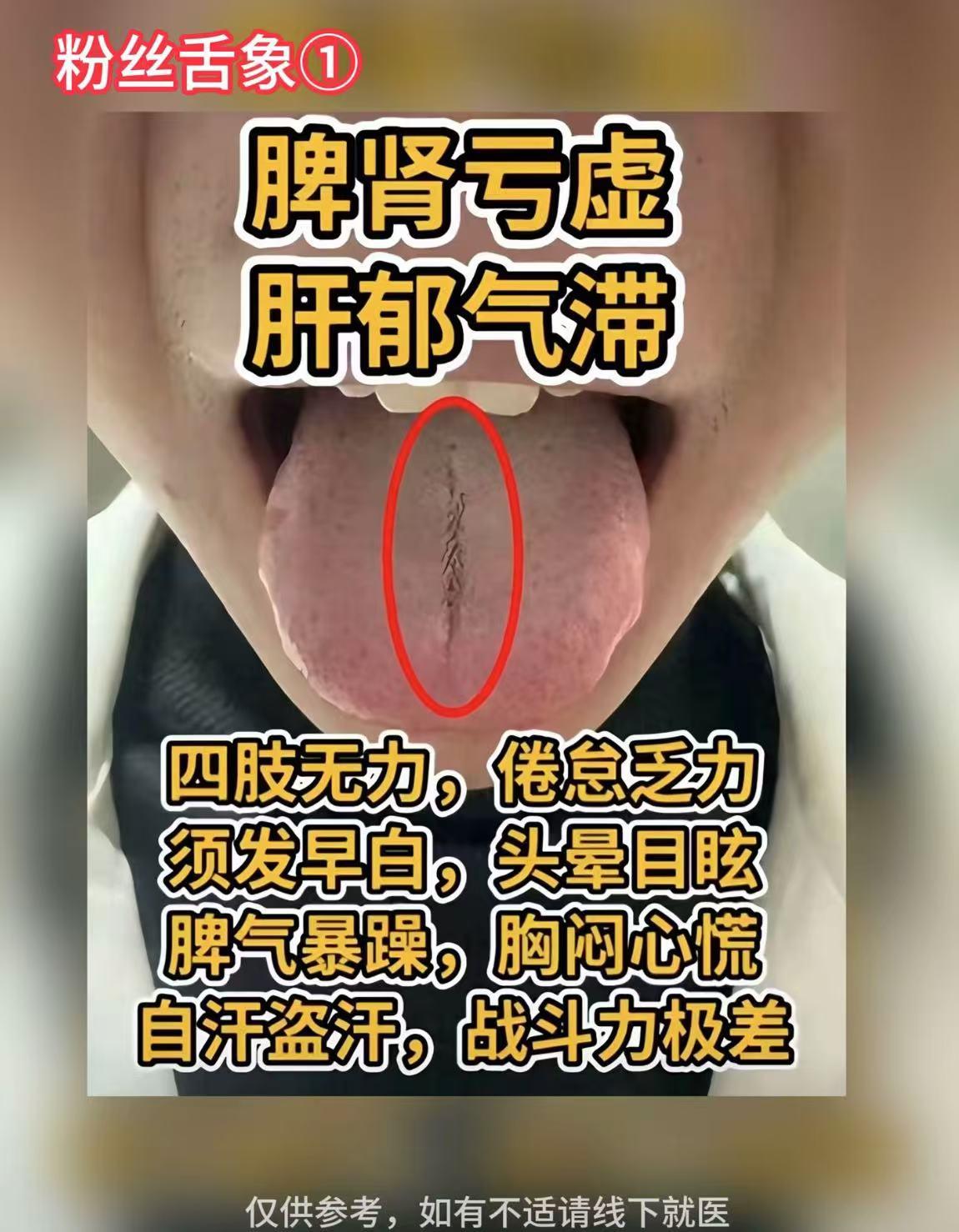 中医张医生：公益舌诊，第2天！你拍我辨，现出结果！

粉丝舌象①
脾肾亏虚、肝郁