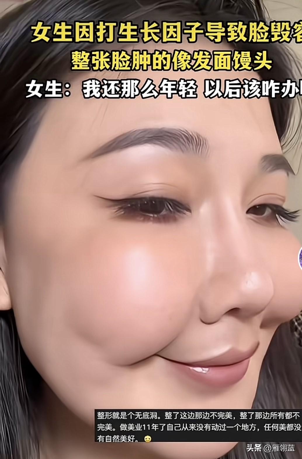 这名女子因为打生长因子，导致脸部像馒头一样，而且全部变形了，现在后悔已经来不及了