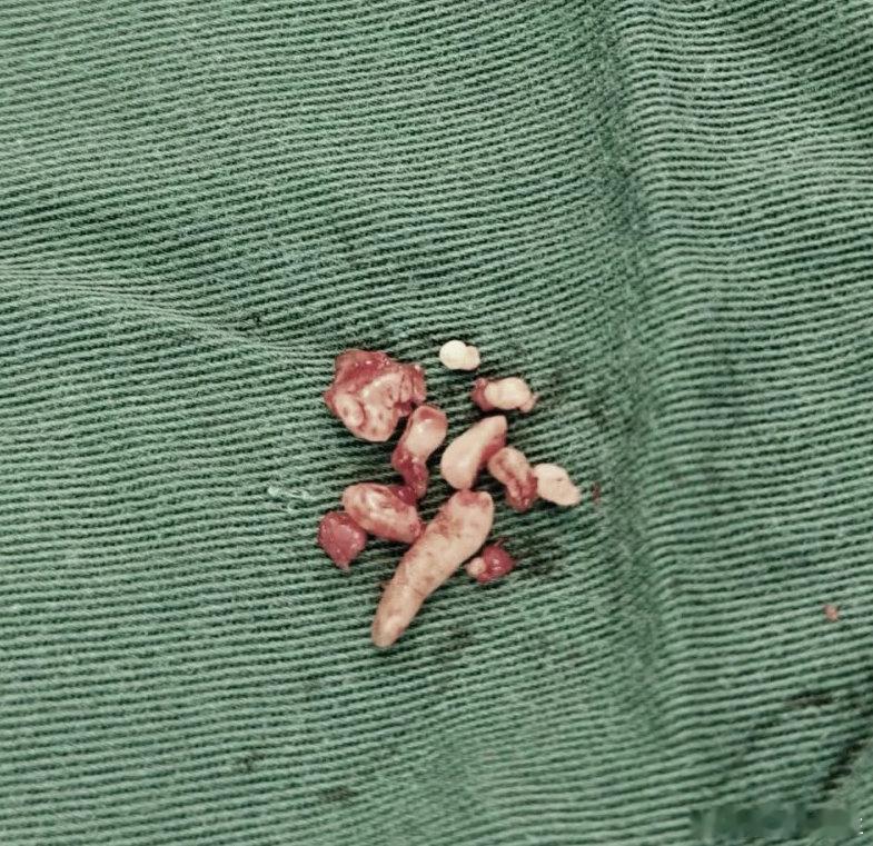 【女子总牙疼发现牙里密密麻麻全是牙】女子总牙疼查出一堆小牙齿 9月7日（发布），