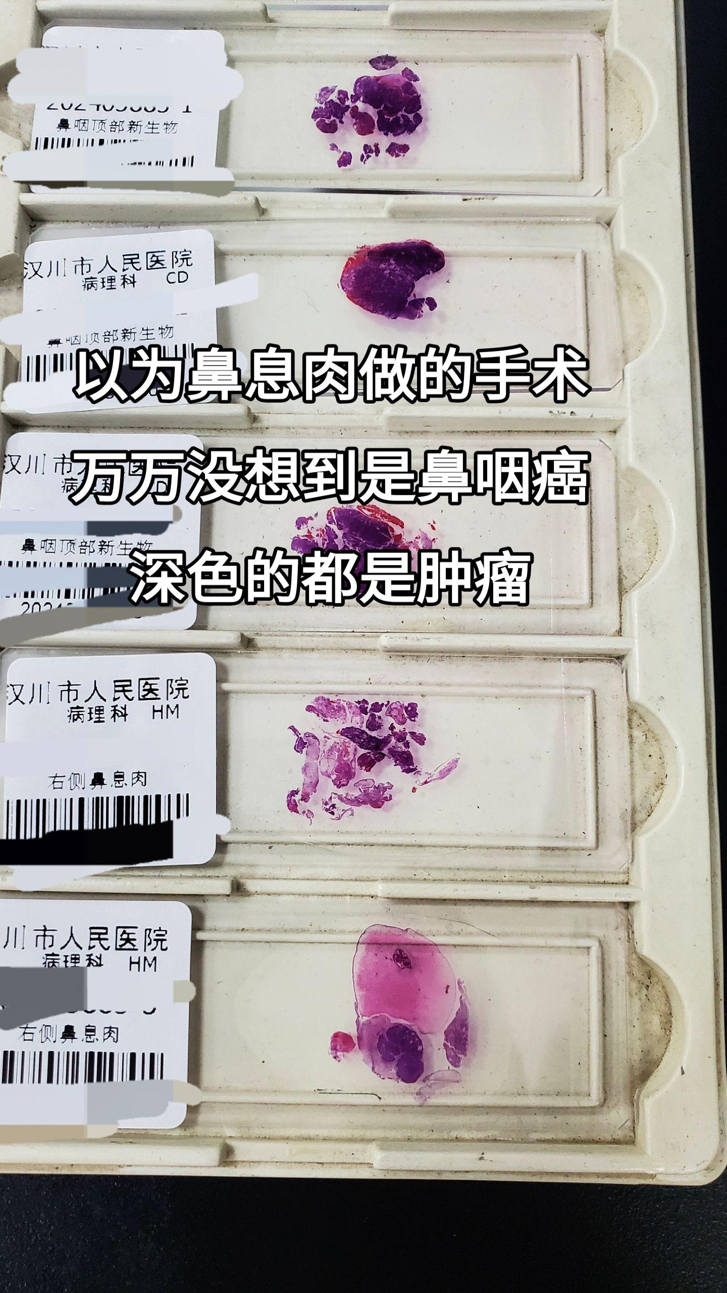 鼻咽癌
