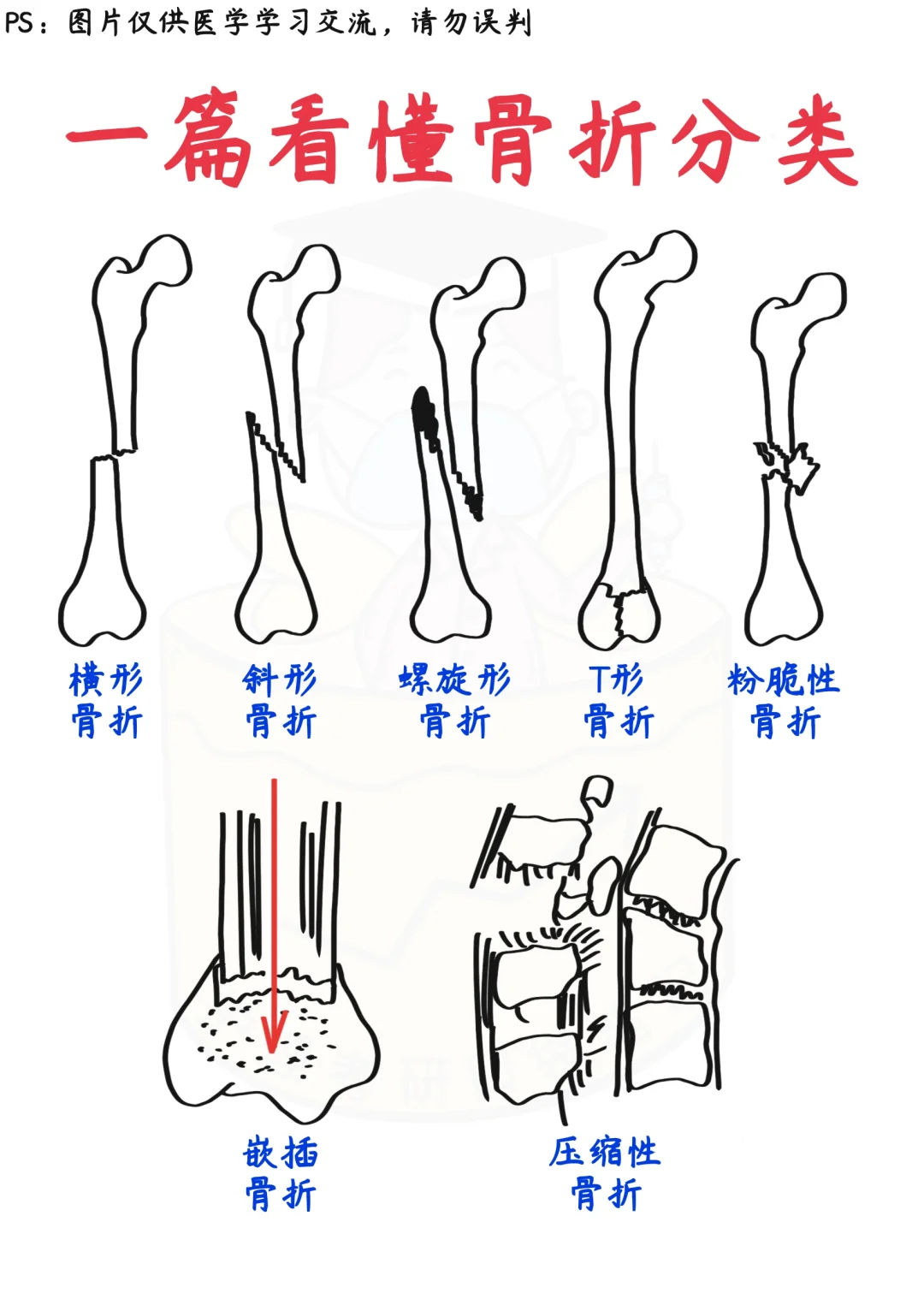 📒医学生笔记｜一图搞懂骨折的分类