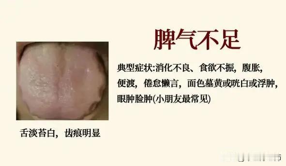 4种常见脾虚的舌象，看看你是哪一种？#健康##舌象分析#