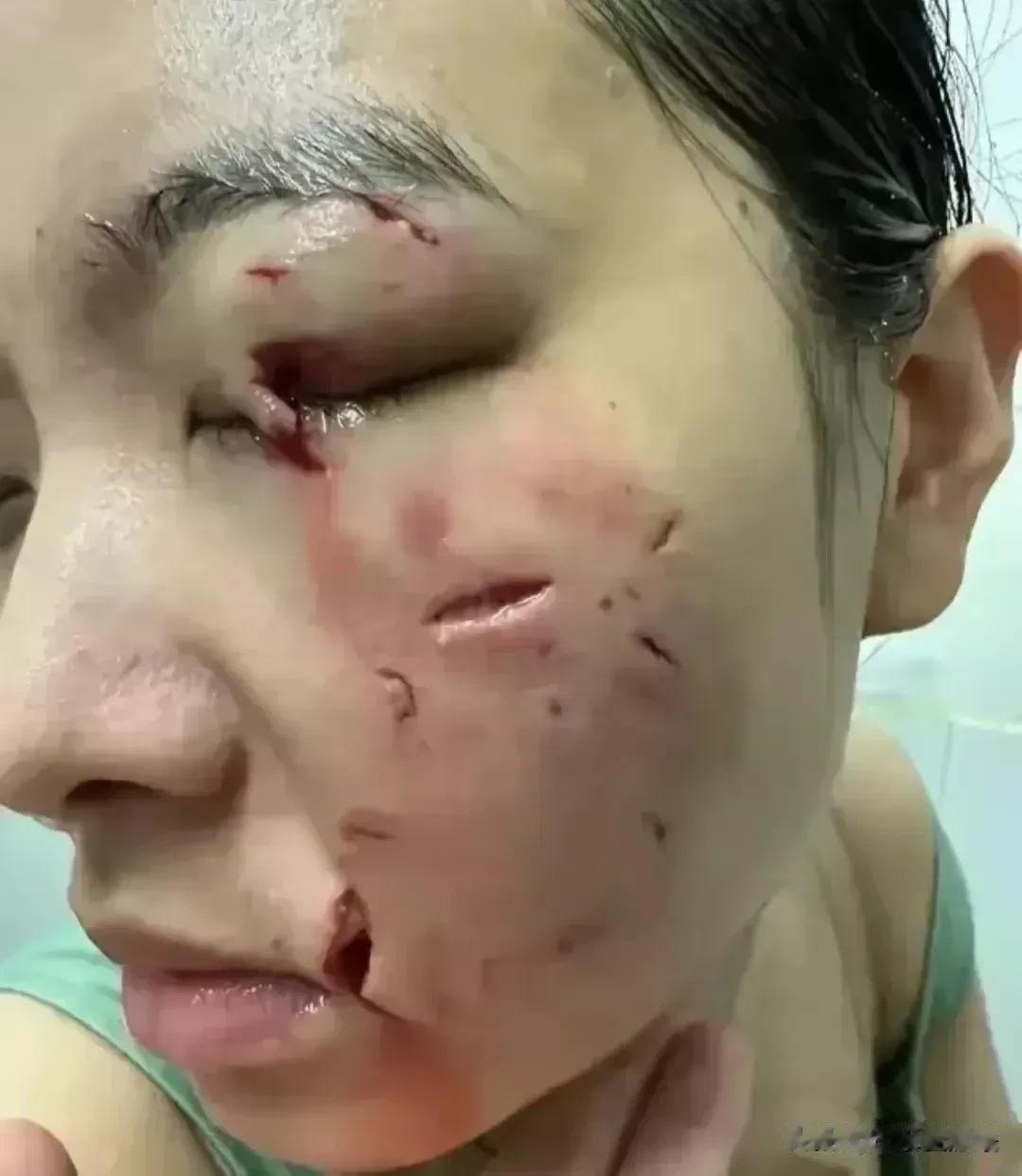 想想都后怕！江苏盐城一女子摸狗头被狗咬伤，主要是脸部多点位被咬，半边脸几乎毁容，