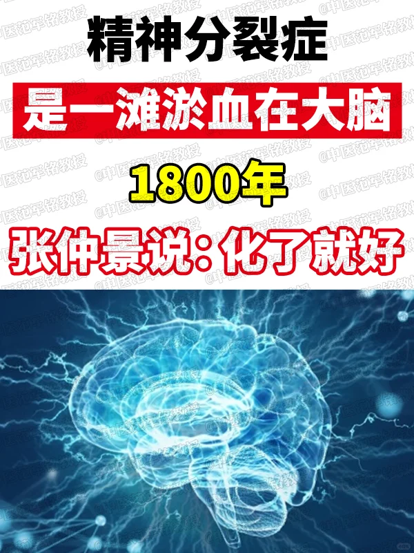 精神分裂症是一滩淤血在大脑，1800年，张仲景说：化了就好