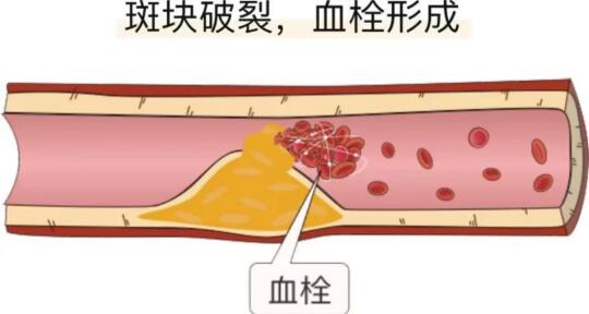 斑块🆚血栓？