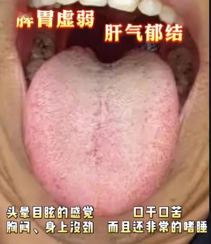 舌象分析
案例1.脾胃虚弱，肝气郁结
症状：头晕目眩的感觉，胸闷、身上没劲、口干