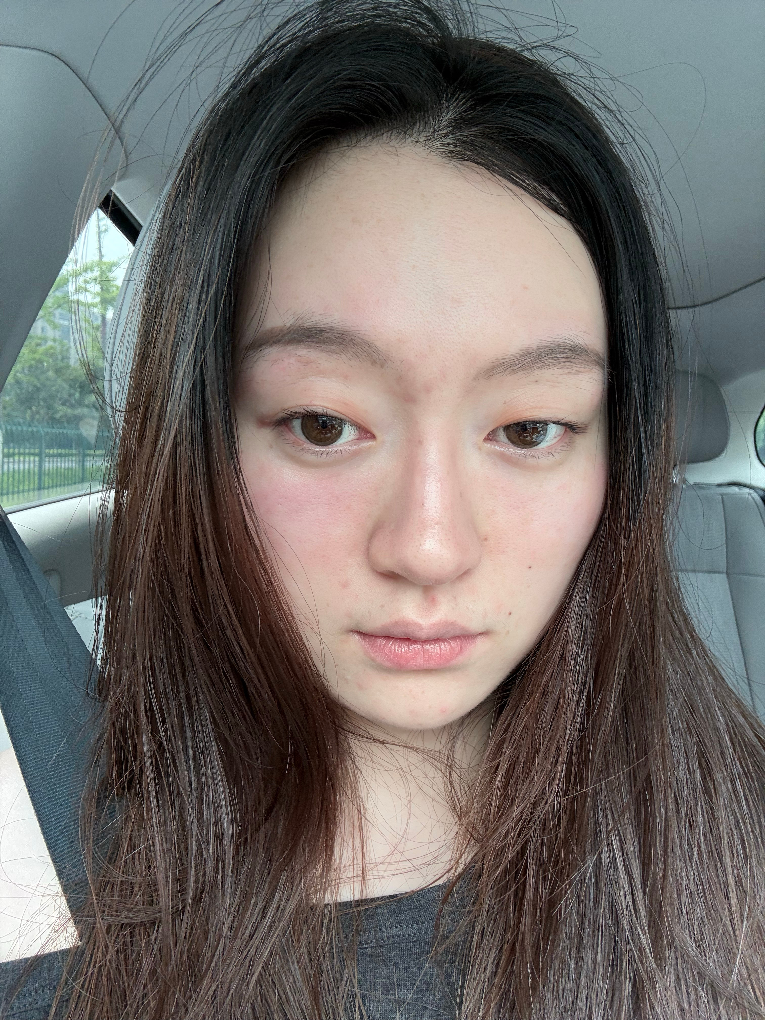 好不容易痘痘好了点 现在又过敏了人生就是这样！一个烂摊子接一个 