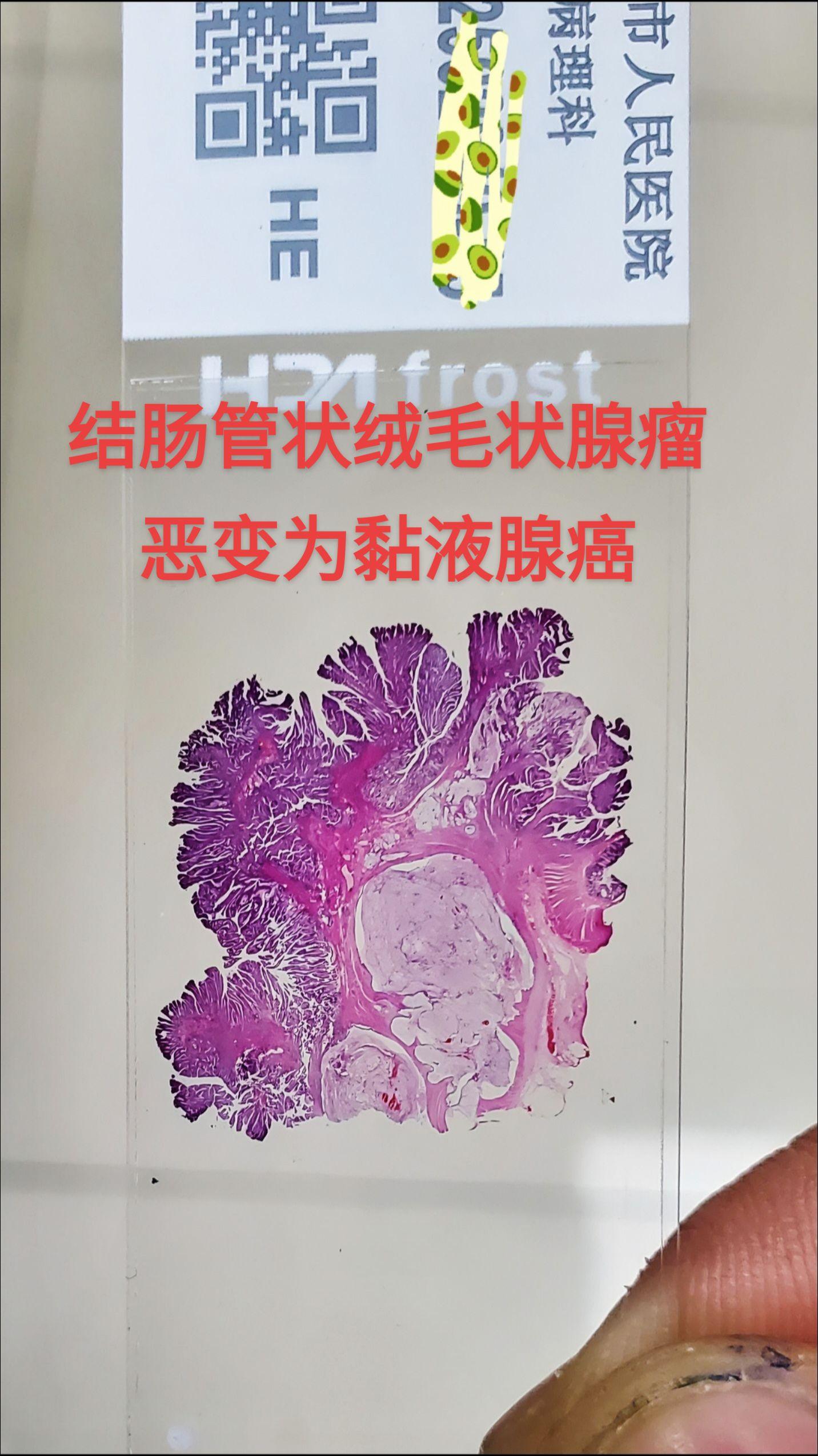 管状绒毛状腺瘤