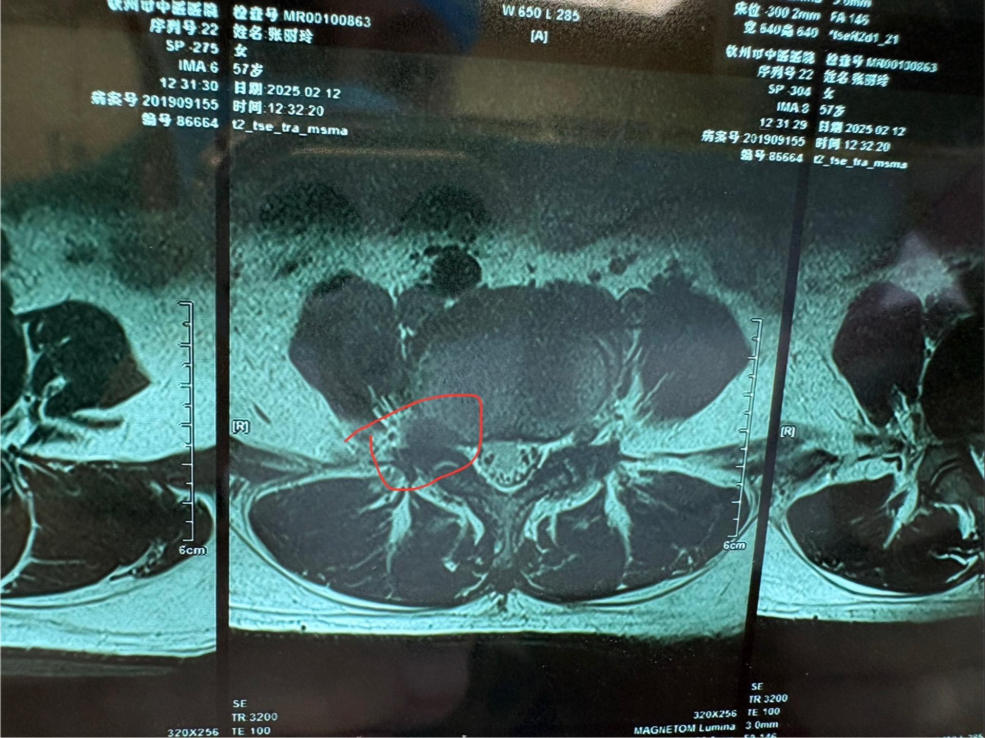 患者右下肢疼痛，磁共振初步看没有大问题，仔细看是极少见的极外侧椎间盘突...