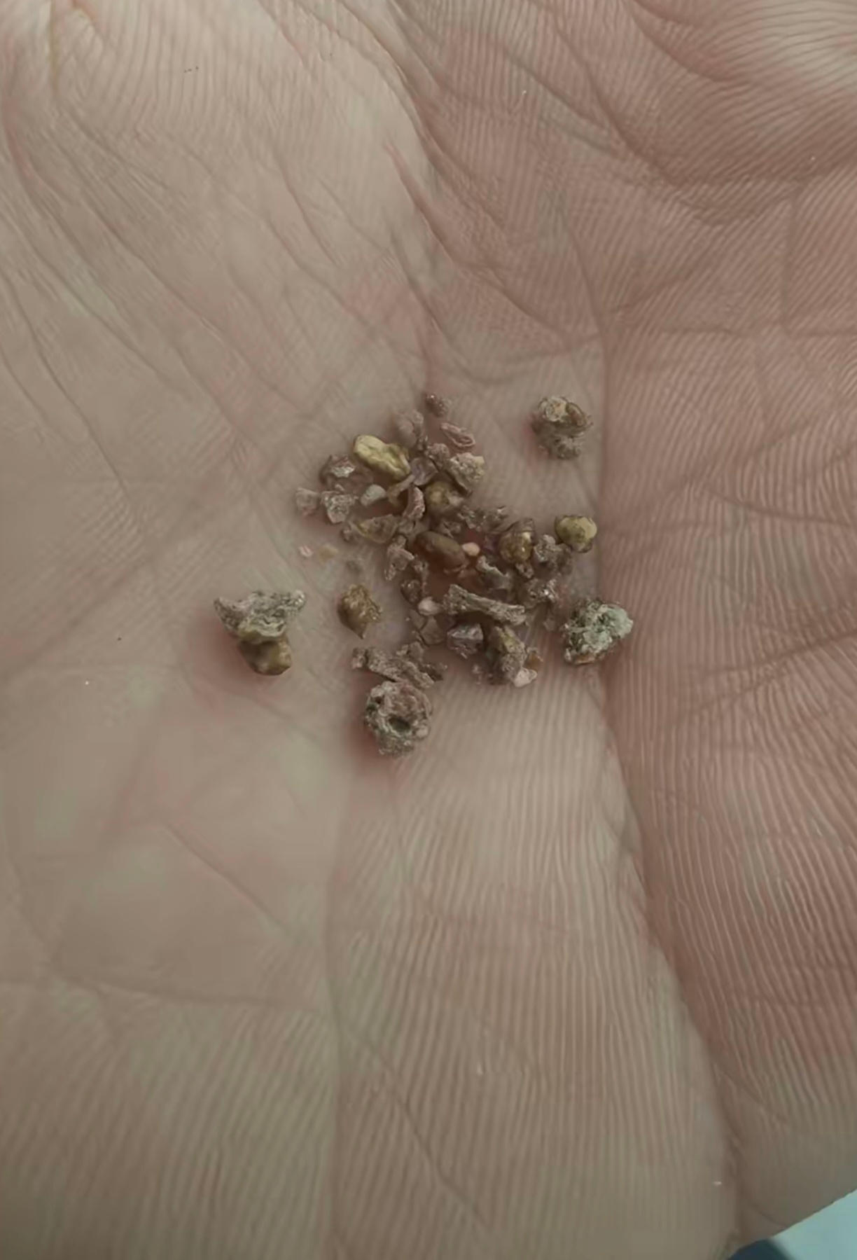 男子膀胱取出2.6斤巨型结石结石能长这么大的？我的天，太夸张了，和椰子一样大了。
