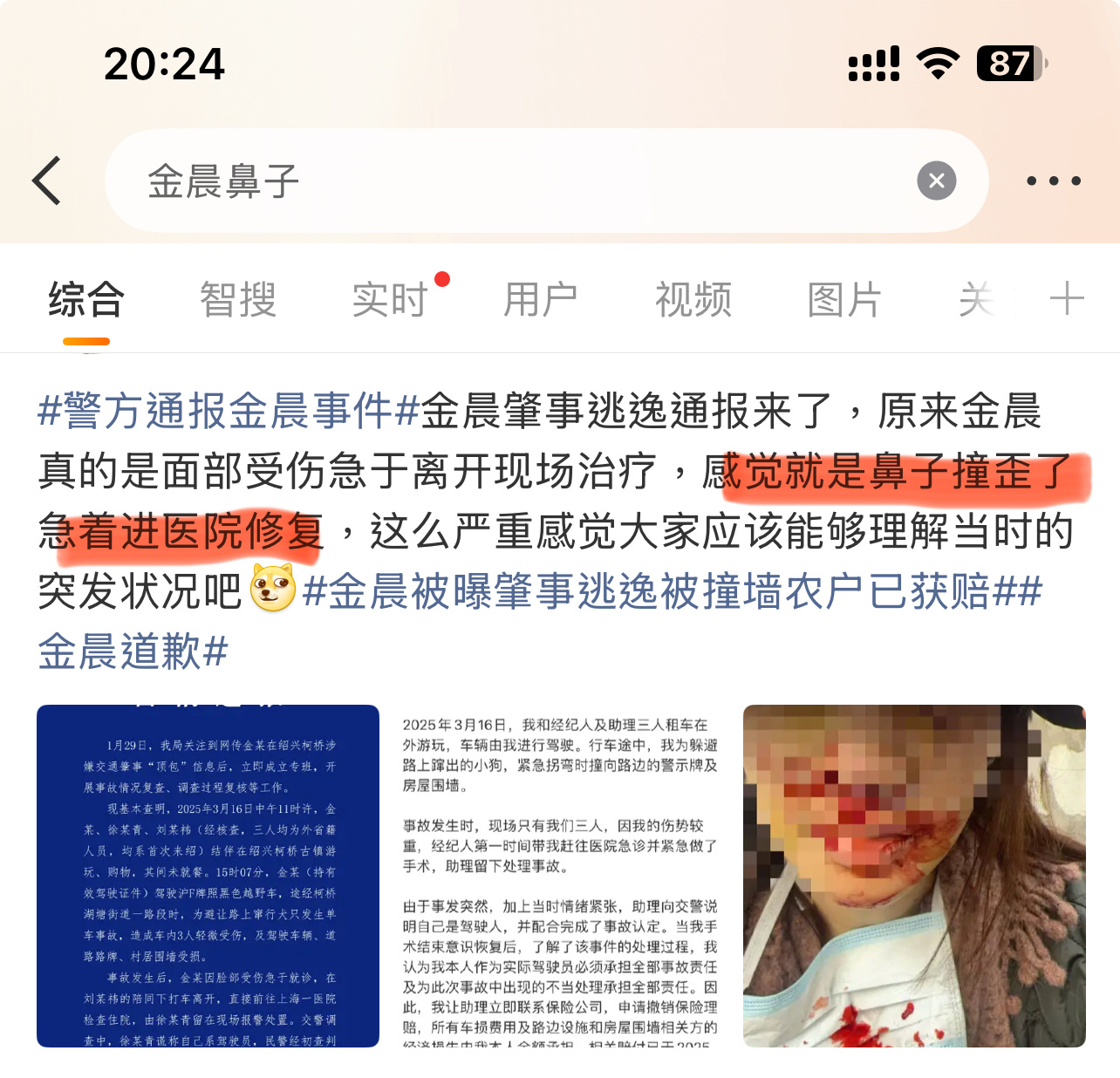 避让小狗，助理顶包，鼻子受伤，紧急前往上海修复？警方通报金晨事件金晨鼻子