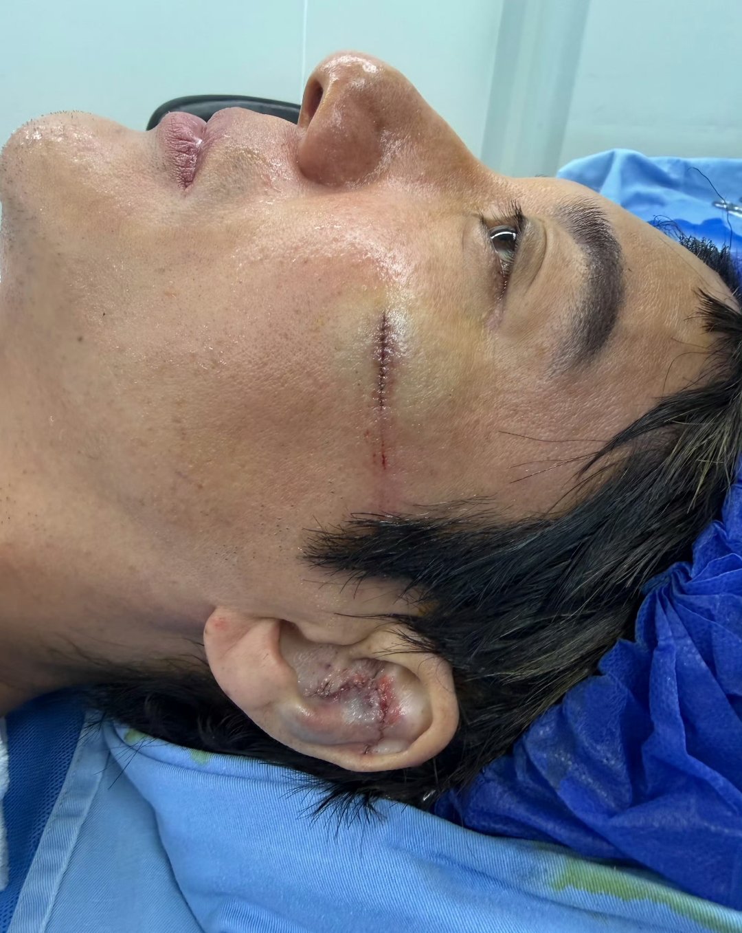 王力宏缝了39针可怕啊，王力宏太敬业了！希望尽快康复。