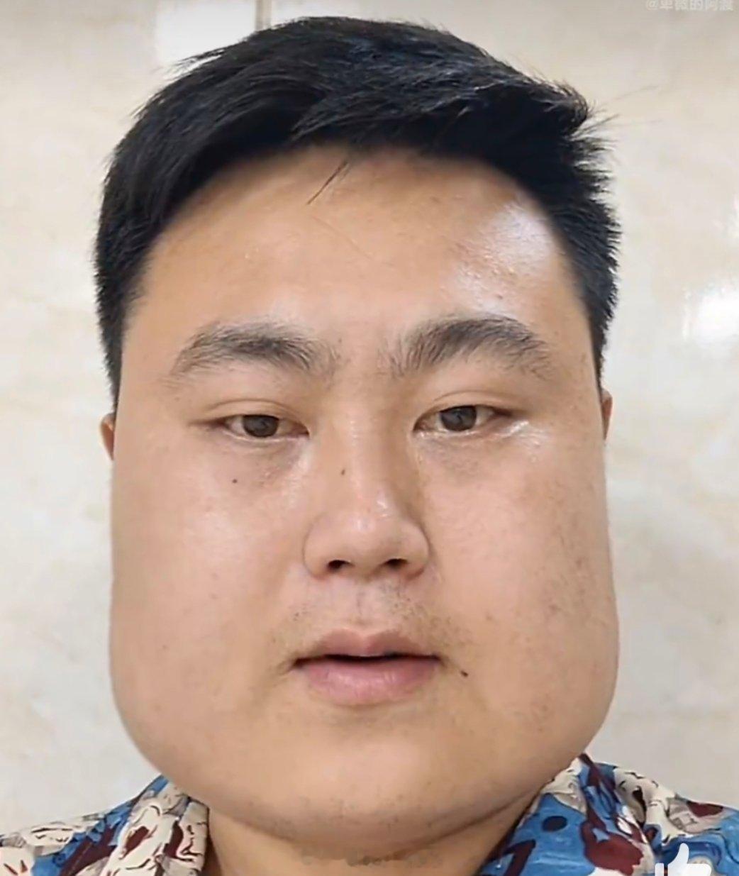 男子吃槟榔18年嘴溃烂张不开我不太理解槟榔有啥好吃的，但是我尊重那些吃槟榔的
