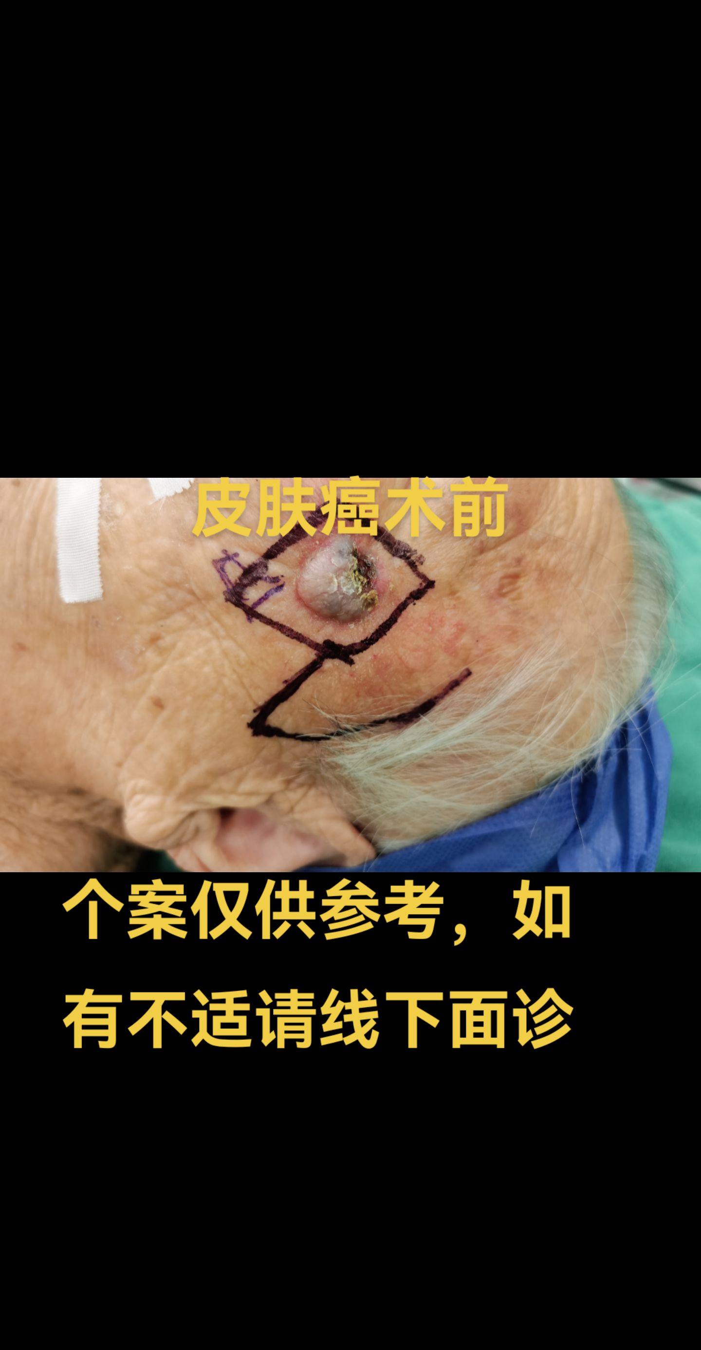 皮肤癌。