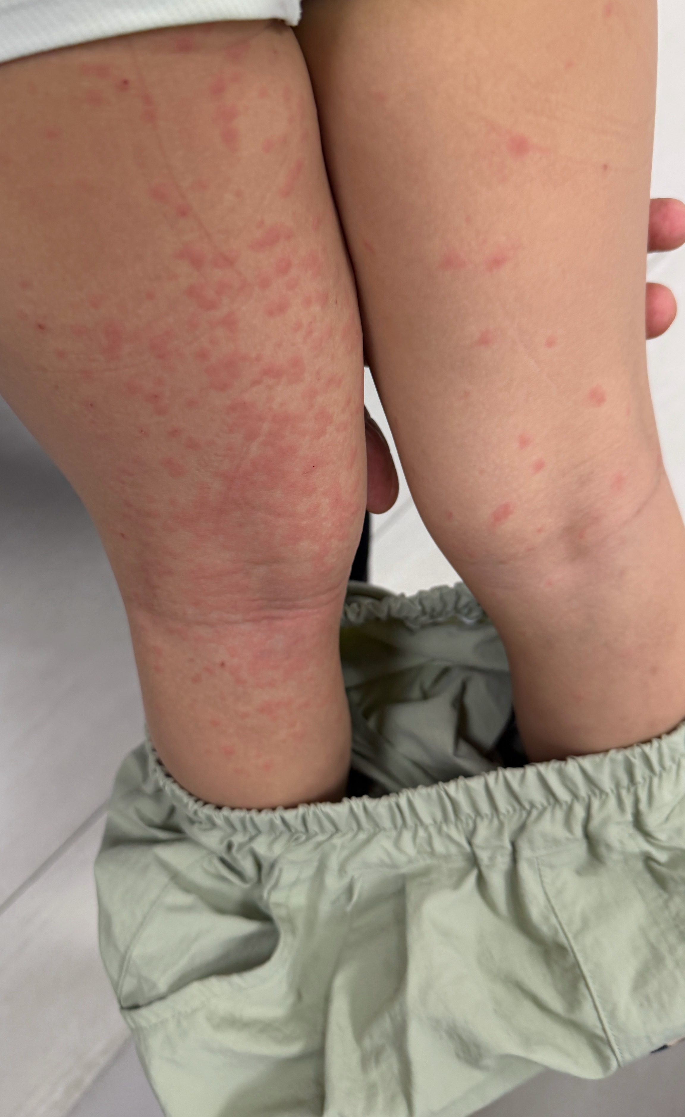 不是药物，可能是外在。给的理由是：药物引起过敏两条腿都会。先配了点药，主要现在需