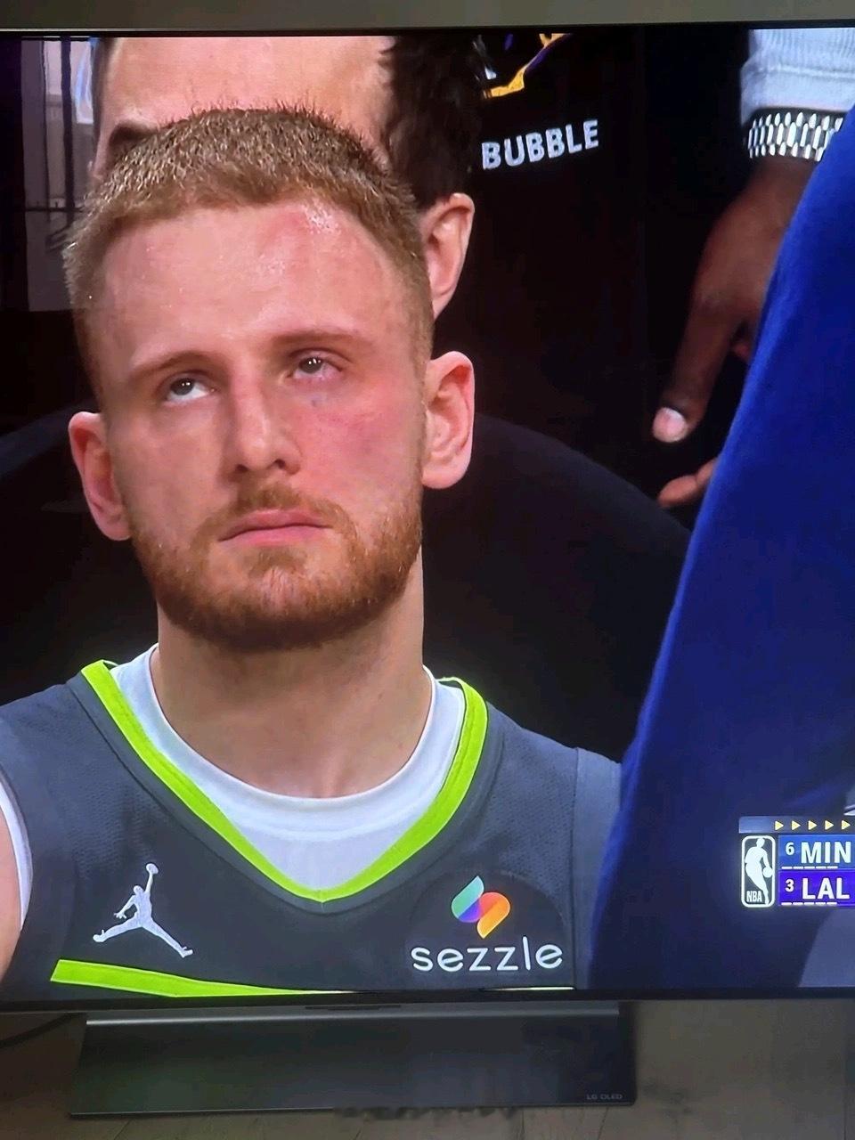 迪文琴佐没事吧？脸被肘肿了，眼睛带血丝…不要影响下一轮的状态啊。森林狼淘汰湖人作