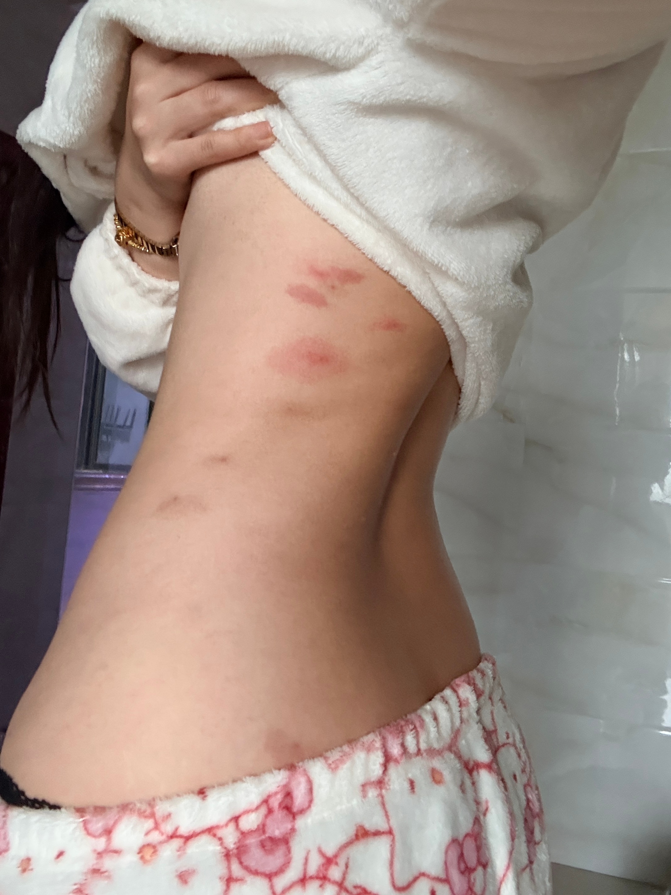 屁股保卫战之“没保住” 