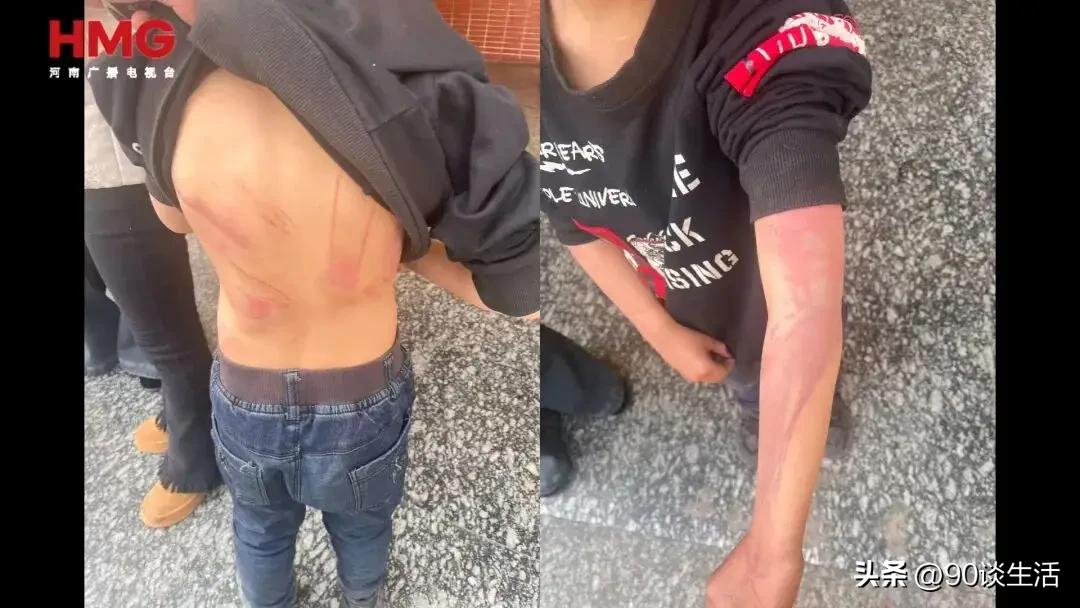 湖南被继母打的这对姐弟，知情人发了三张孩子受伤和伤情鉴定书的照片，伤痕触目惊心。