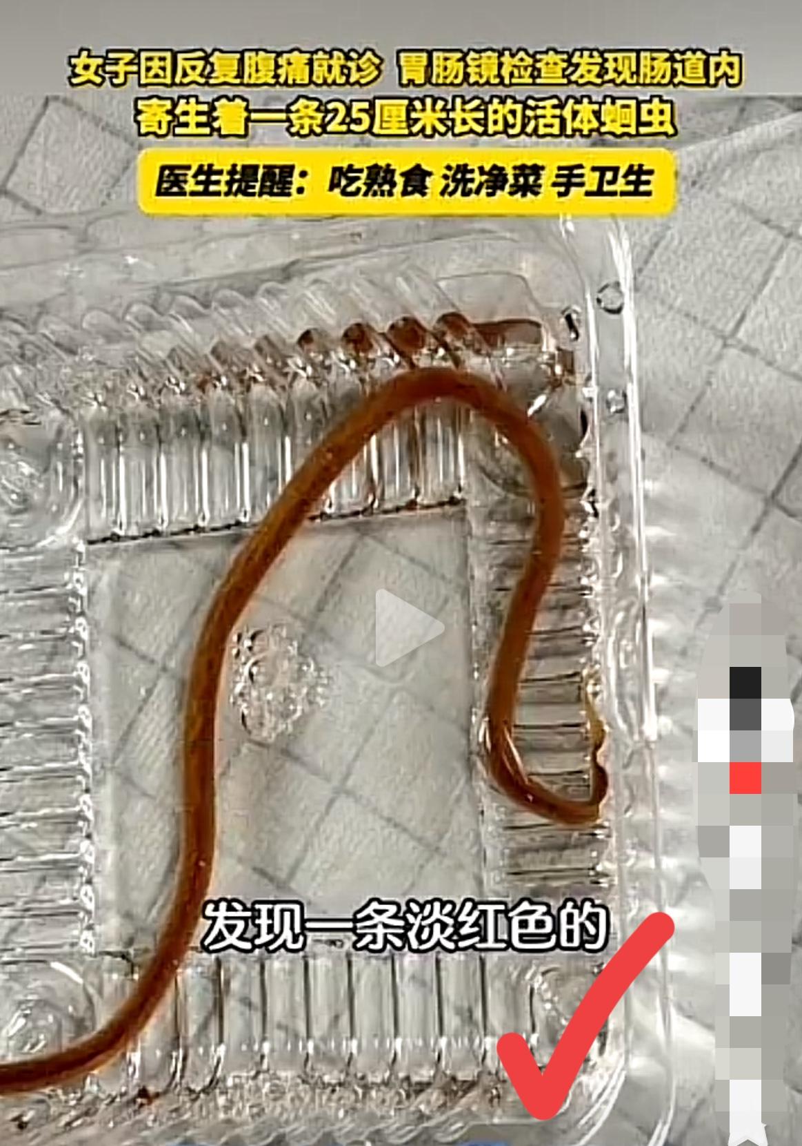 25厘米的蛔虫！
这位女士自己都不敢相信吧！
奉劝所有人吃熟食！熟食！熟食！
