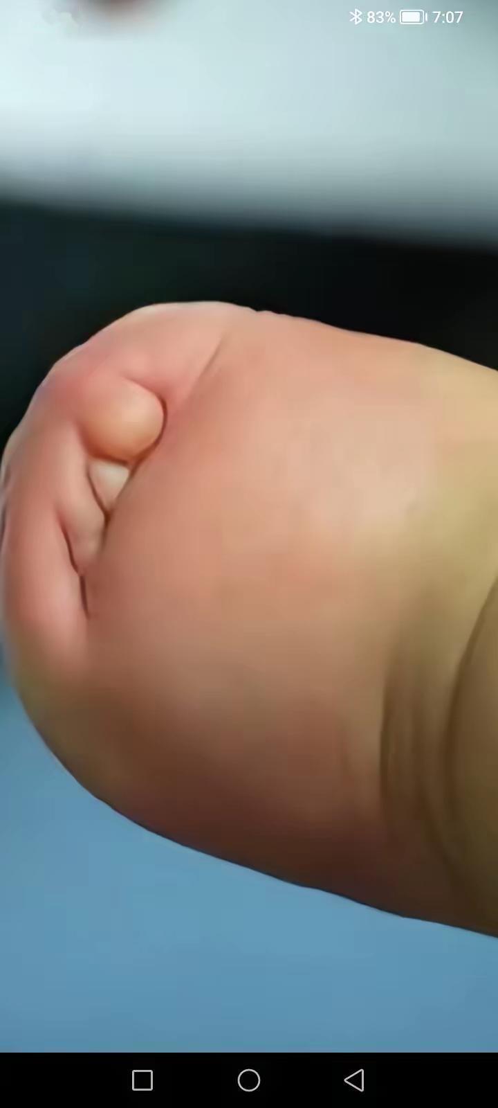 宝宝生了，妈妈哭了，宝宝生下来脚畸形，脚长的向个小面包，脚趾都没长开，宝爸问医生