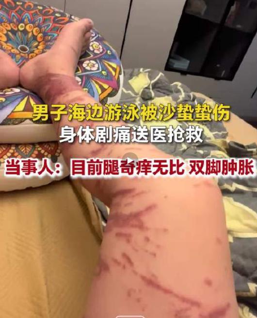 万万没想到！山东日照，男子下海游泳，谁能想到在浅水区突然遭遇了水下“隐形杀手”，