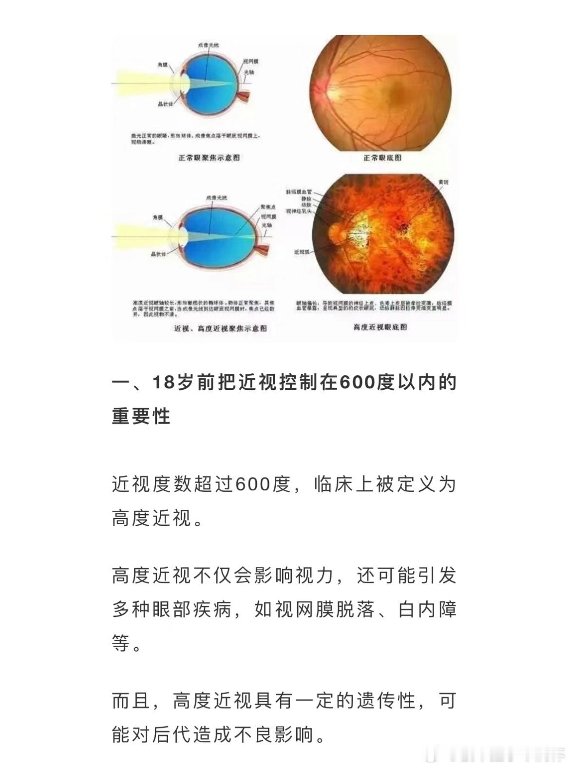 #18岁前把视力控制在600度以内# 18岁前把视力控制在600度以内的重要性#