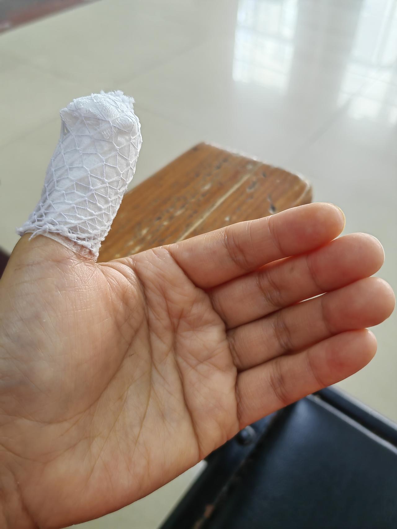 受伤了，可怜我的左手拇指。我对自己也太“狠”了，手起刀落，玉米没斩开，把手指斩伤