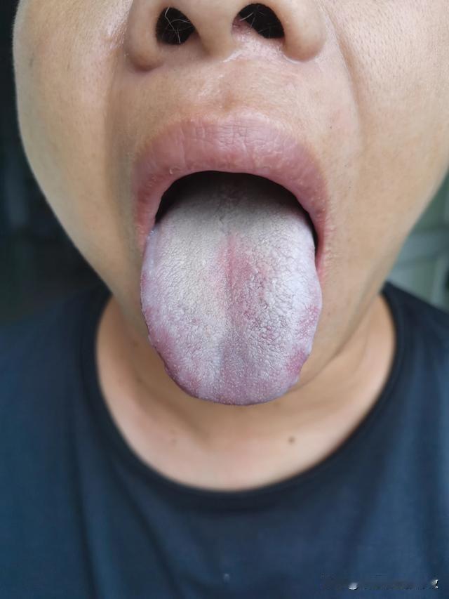一到夏天，一个个咋都成这了[捂脸][捂脸]最近门诊一个接一个
主诉：拉肚子，不敢