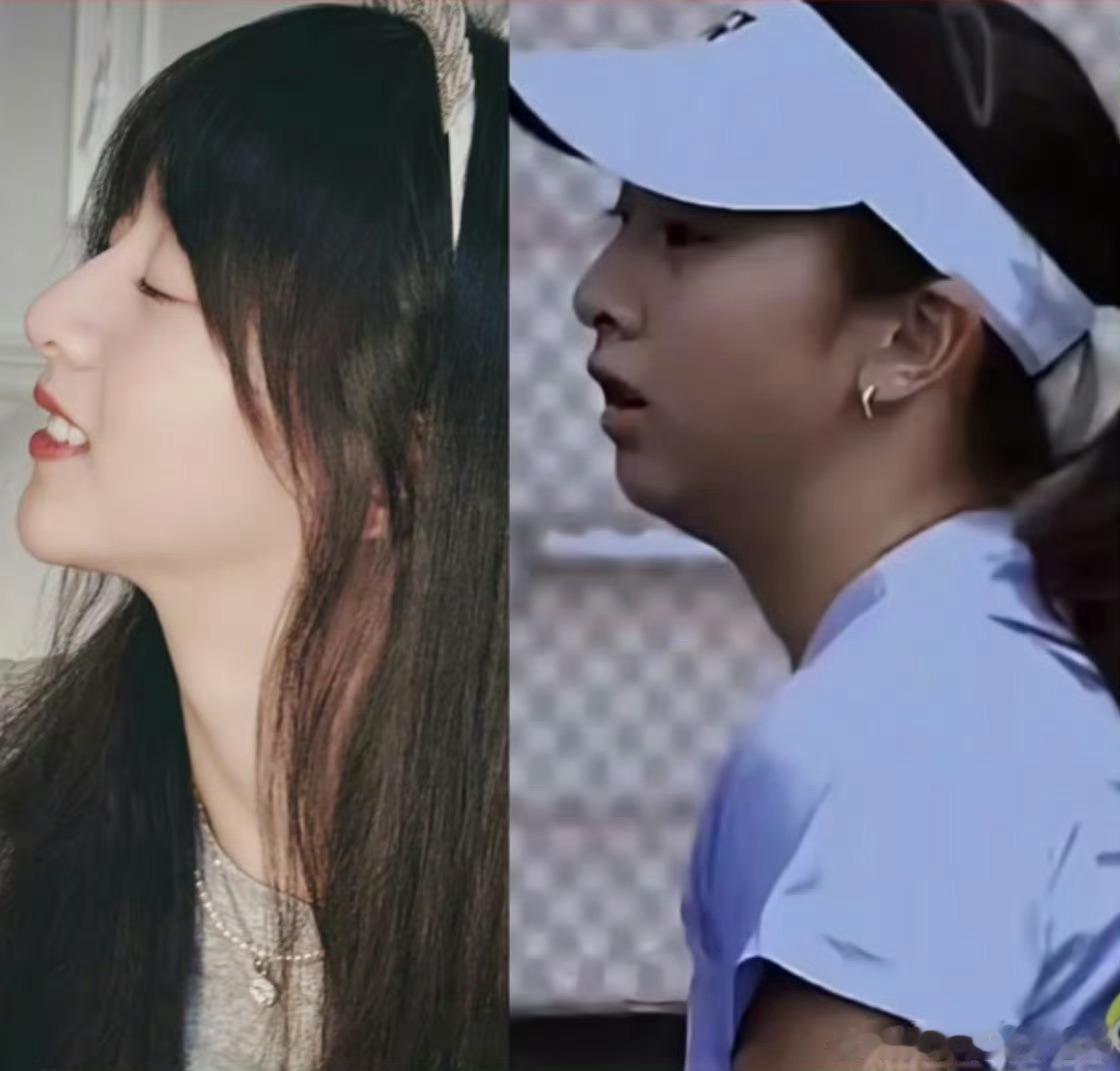 森碟下巴后缩矫正好了为什么不早点干预呀 