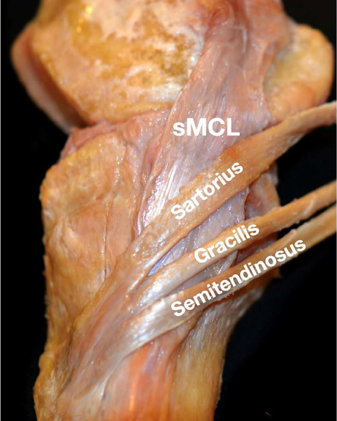 膝关节损伤 刚刚说了内侧副韧带，来看看真实的它，还有我们的鹅足。我之前说，肌肉的