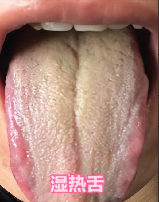 体内有没有湿热，主要看这两点：舌苔和饭量
 
因为当体内湿热过重时，会不停的熏烤