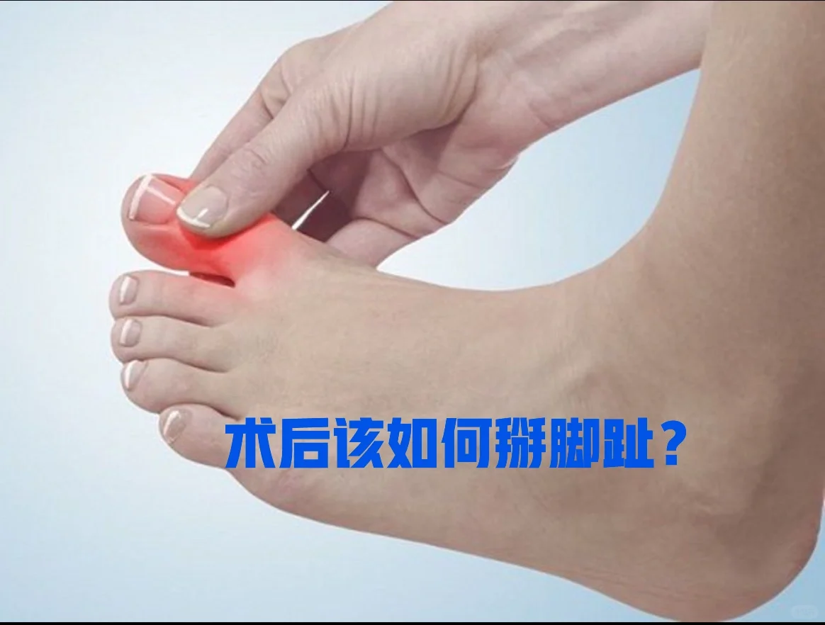 拇外翻术后改如何掰脚趾？