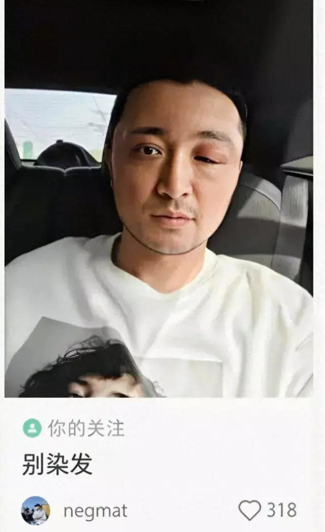 2026年4月15日，央视主持人尼格买提晒出眼部肿胀照片，发文劝大家别染发。原来