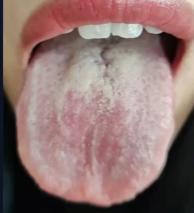 【舌诊分析】胃不舒服怎么回事？听中医给你辨证分析！

我们来看这位朋友的舌象，具