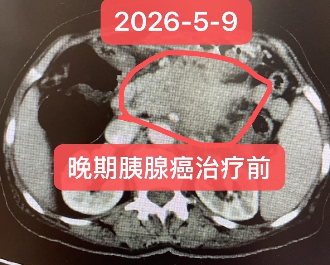 晚期胰腺癌的救治。患者女，71岁，活检：胰腺导管腺癌！ 一线（2025...
