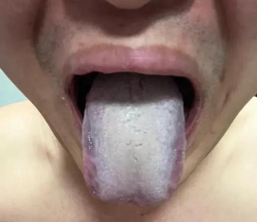 出现这种舌象，你不去调理，还在等什么？

看这个舌象，典型的寒凝血瘀，患者说男科