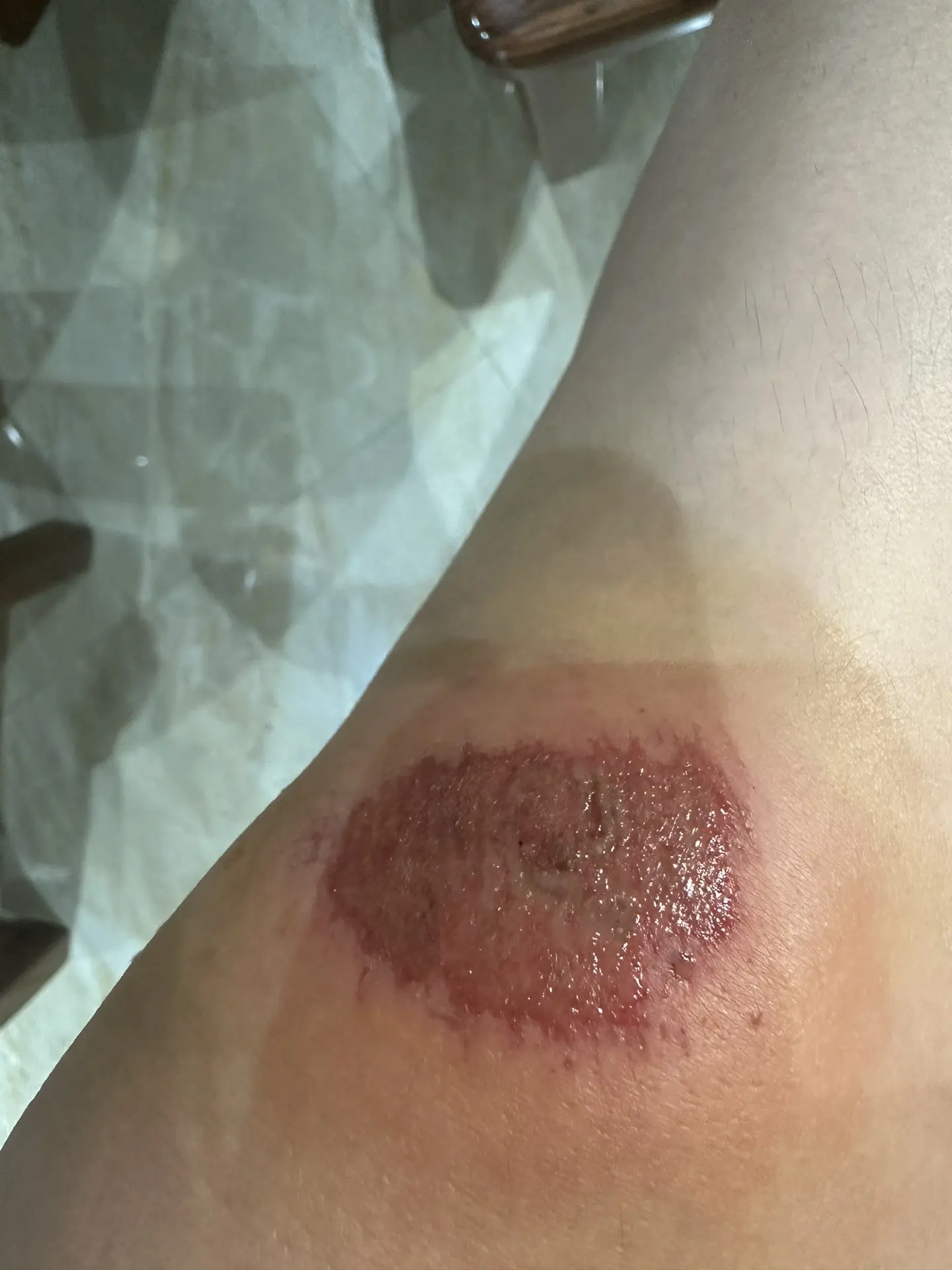 擦破皮流血两个月有疤了，还能治愈吗？