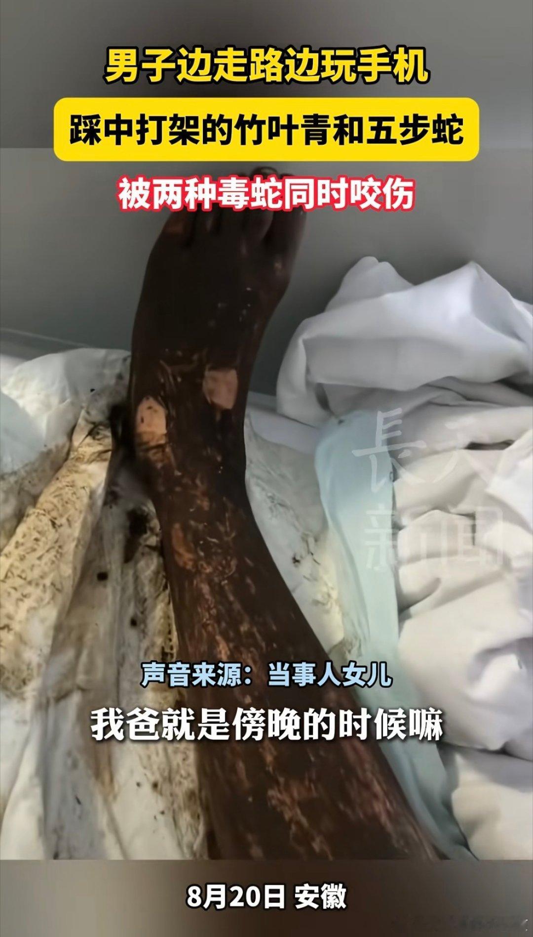 被两种毒蛇同时咬伤…这运气[允悲]是不是告诉我们走路千万不要玩手机？ ​​​