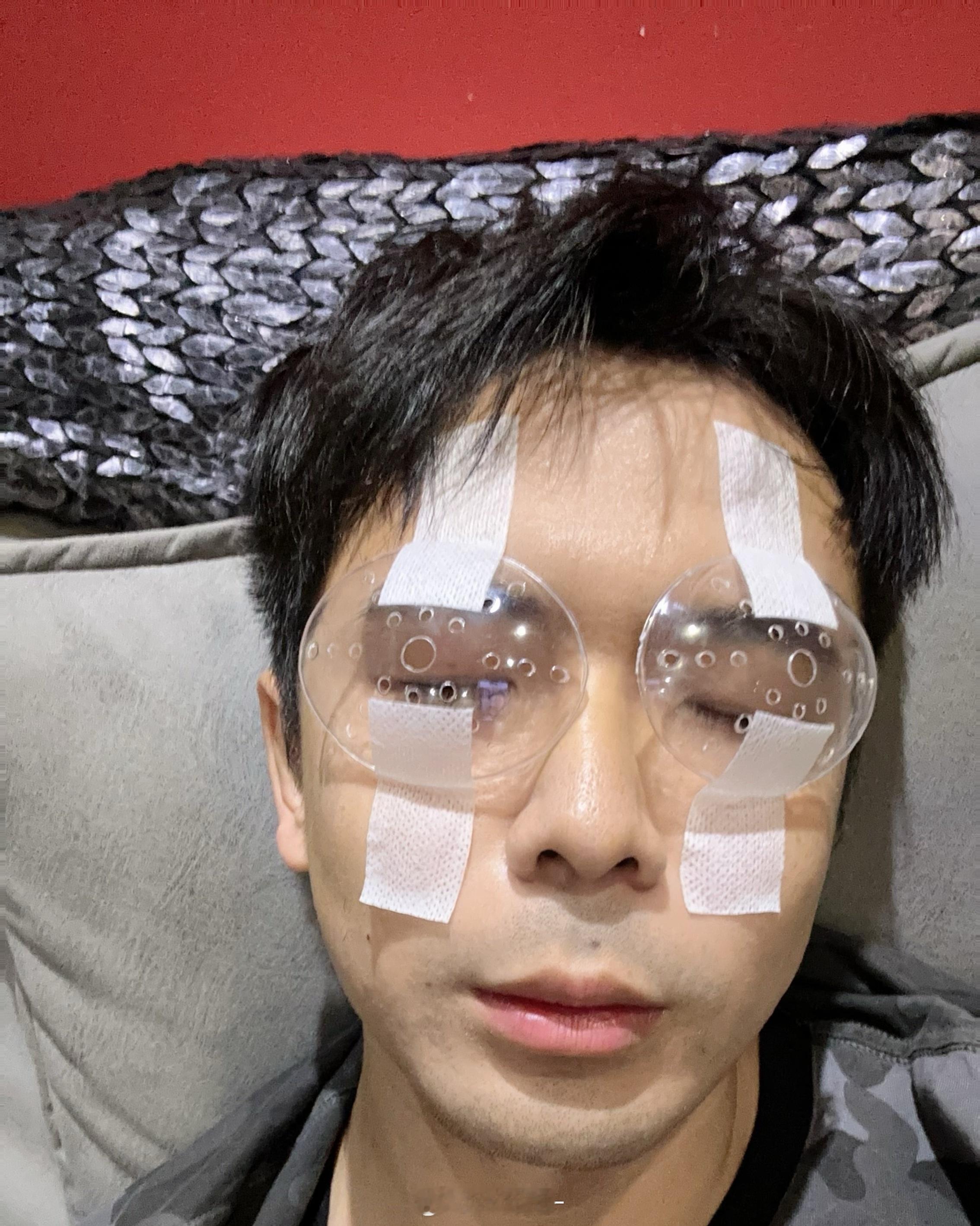 近视手术到今天一个月简单和大家说一下我的经过和状态 供大家参考度数：775 左右