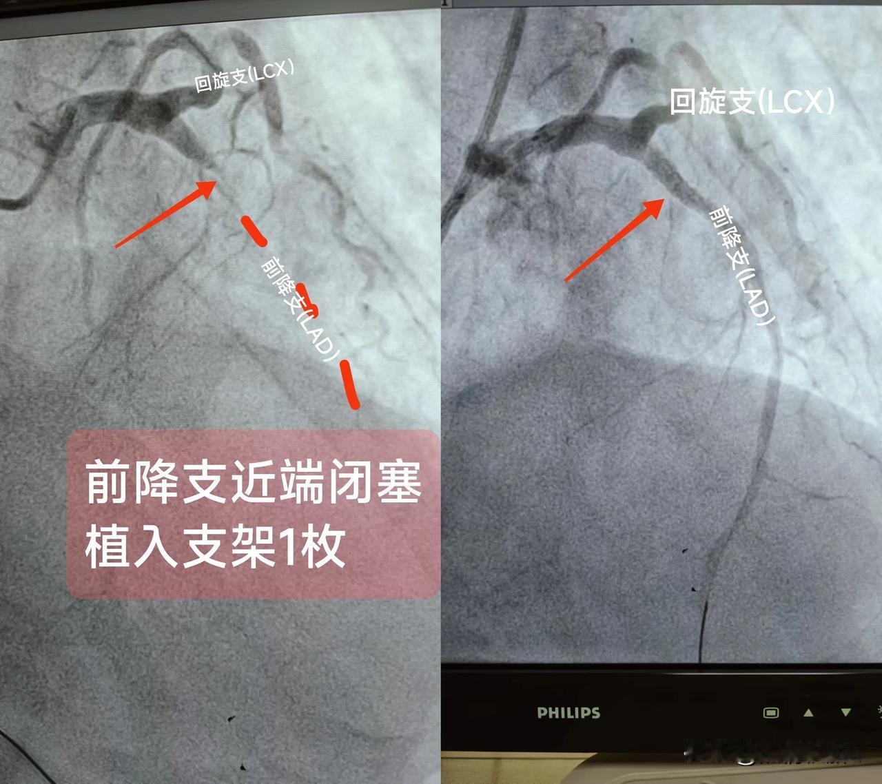 急性ST段抬高型心肌梗死
（前降支近段闭塞)
一.概念：
前降支主要为前壁及前间