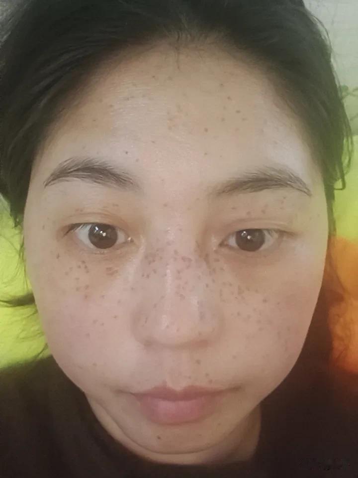 这是我皮秒祛斑第三天的效果，脸部感觉很痒，忍住忍住不抓，坚持就是胜利。