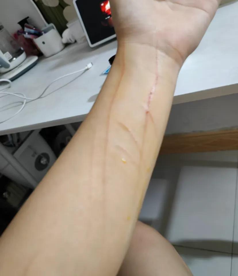 被猫抓了
气死我了，好吃好喝得供着，生病了花钱给它治病，不开心了买新玩具，猫粮吃