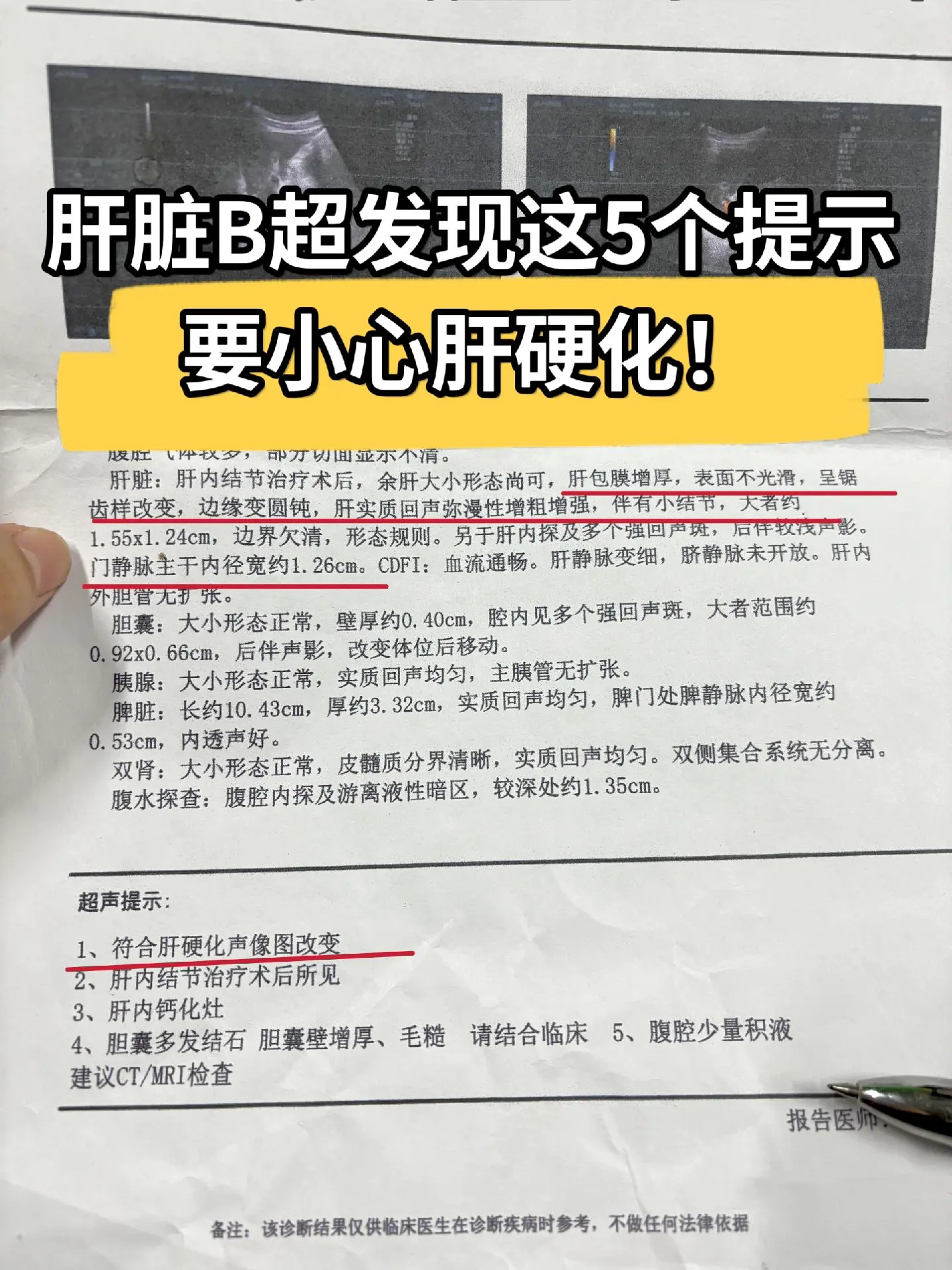 肝脏B超发现这5个提示要留意！1、肝实质发生变化：当肝脏内组织发生变性...