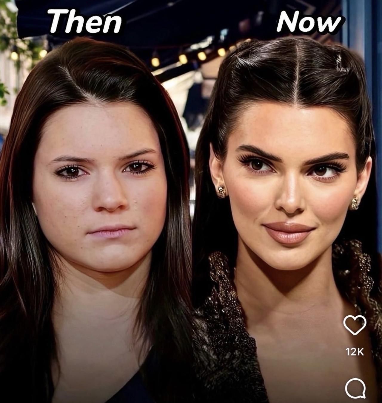 肯达尔·詹娜否认整形手术传闻：

“我从未对脸部做过任何手术。我只做过两次‘肉毒