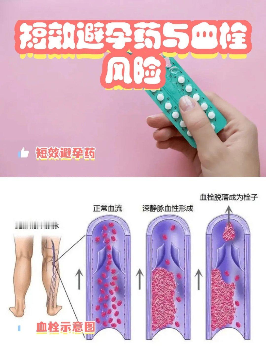 避孕药 血栓26岁女生连服数月避孕药又长途久坐，突发肺栓塞险丧命，研究证实含雌激
