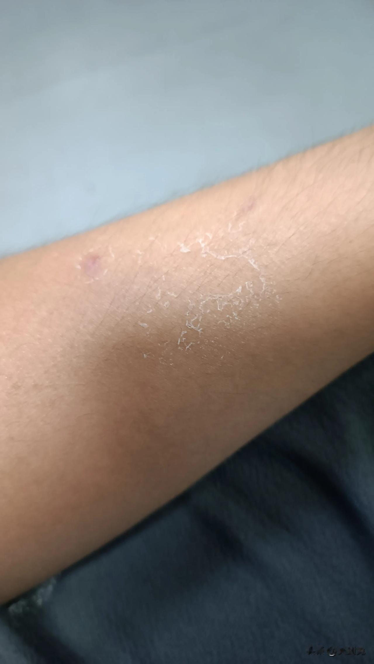 国庆节千里迢迢去“人鱼洞”看美人鱼，结果美人鱼没见到，反而把自己的两只手晒脱了一