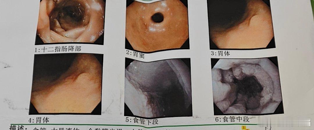 这两个月发现两个贲门失弛缓症，都是纯依靠胃镜发现的，先看有没有食管潴留，再看贲门