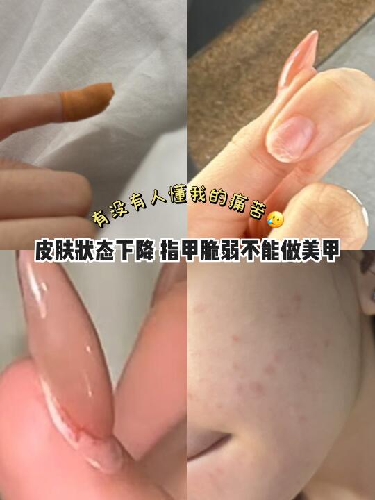 🇲🇾指甲盖脆弱到不能做美甲的痛..