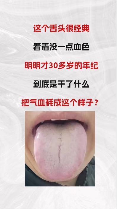 看这个舌头，非常经典，一点血色都没有，明明年纪轻轻，才30多岁，到底是干啥了，竟