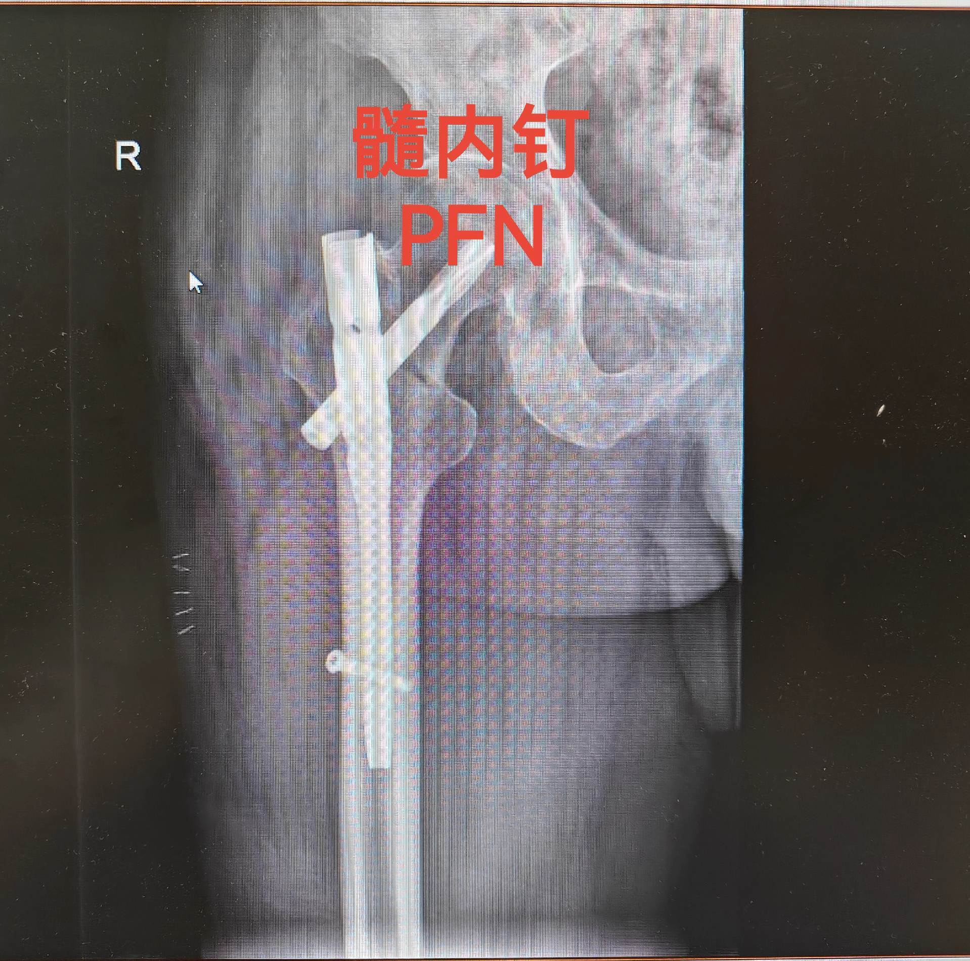 股骨颈骨折。老年体弱股骨颈骨折患者，人工股骨头置换可以使其立即下床，但...